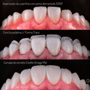 etapas das facetas dentárias
