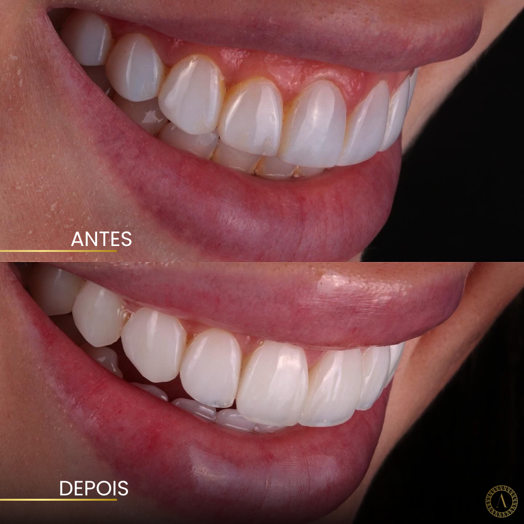 Elegância Refinada - Antes e Depois