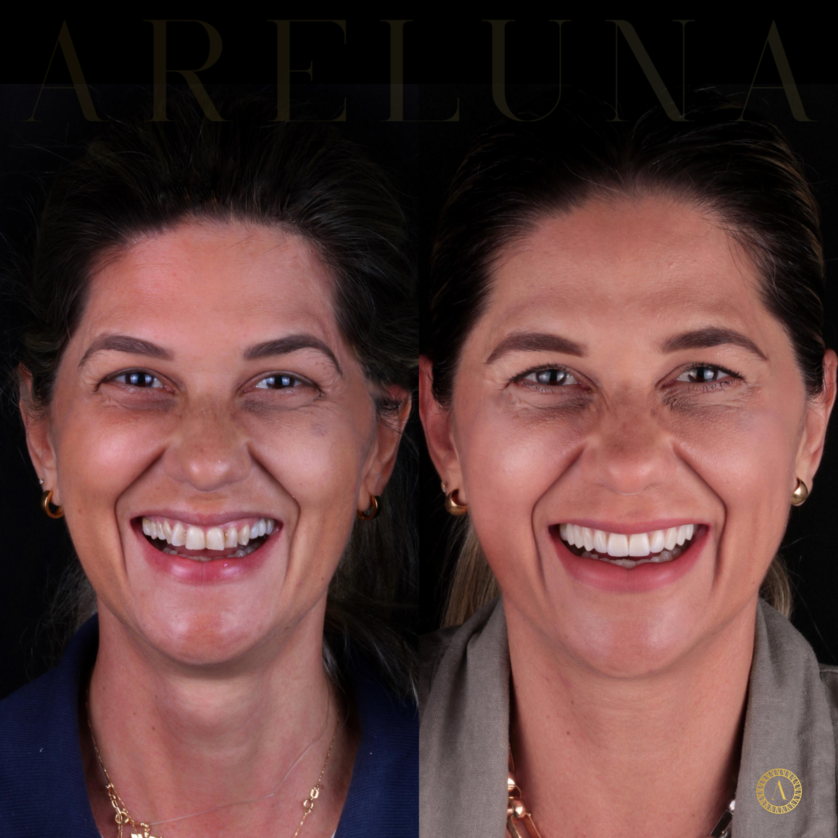 Facetas cerâmicas - Antes e Depois