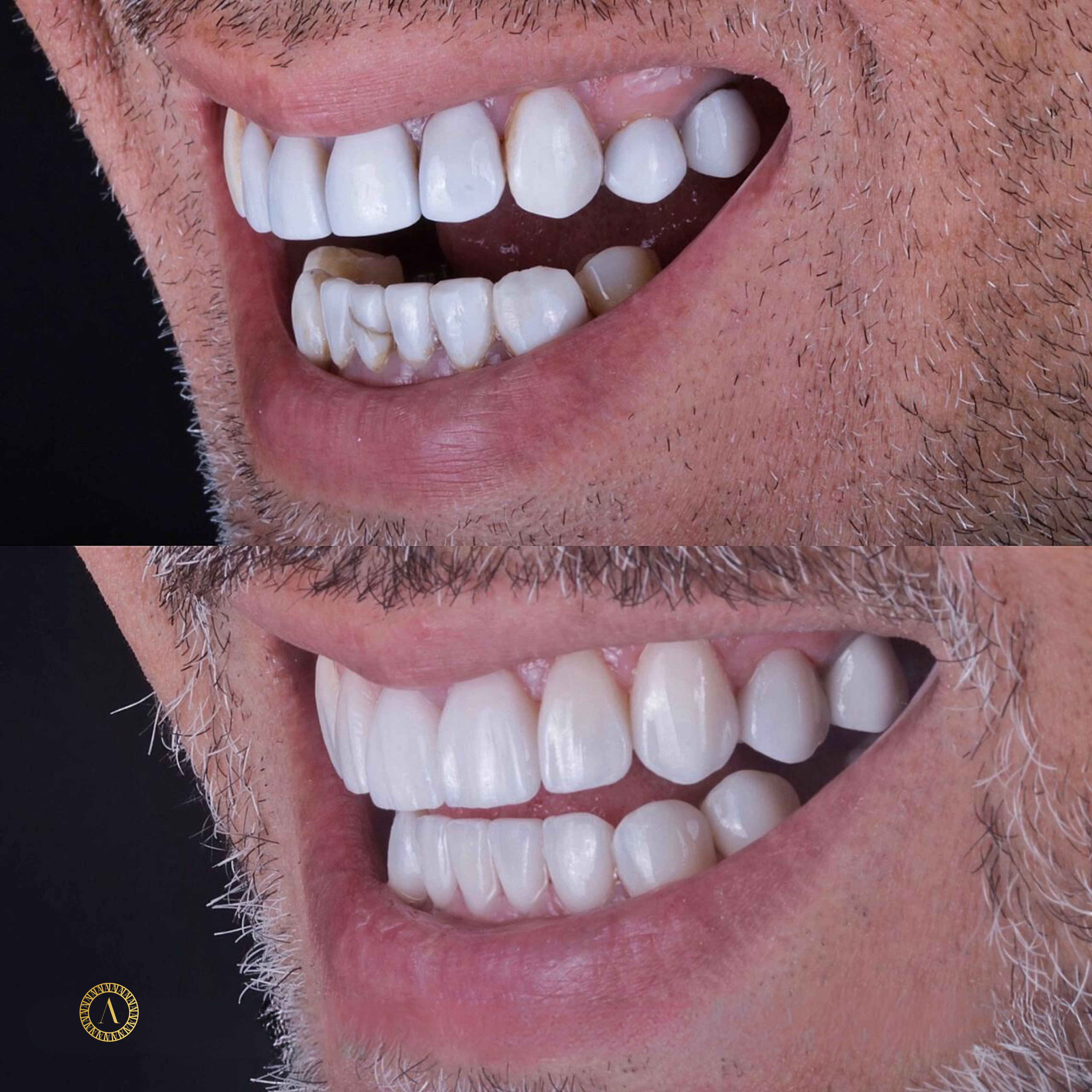 Perfeição Natural - Antes e Depois