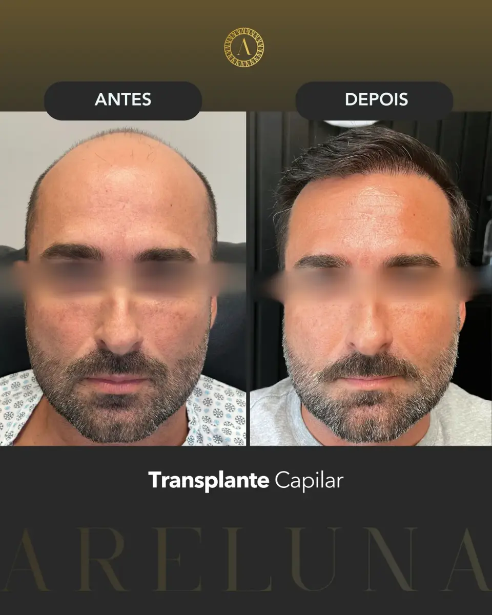 Caso clínico de transplante capilar FUE, publicado com autorização do paciente