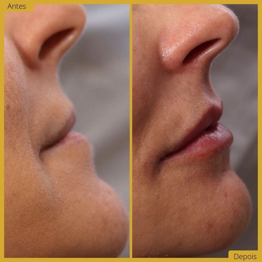 Ácido hialurónico