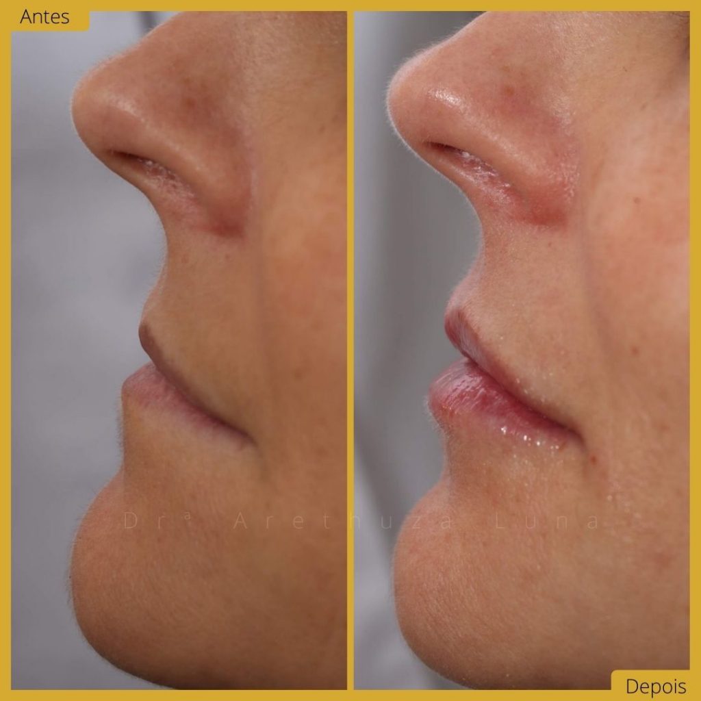 Ácido hialurónico