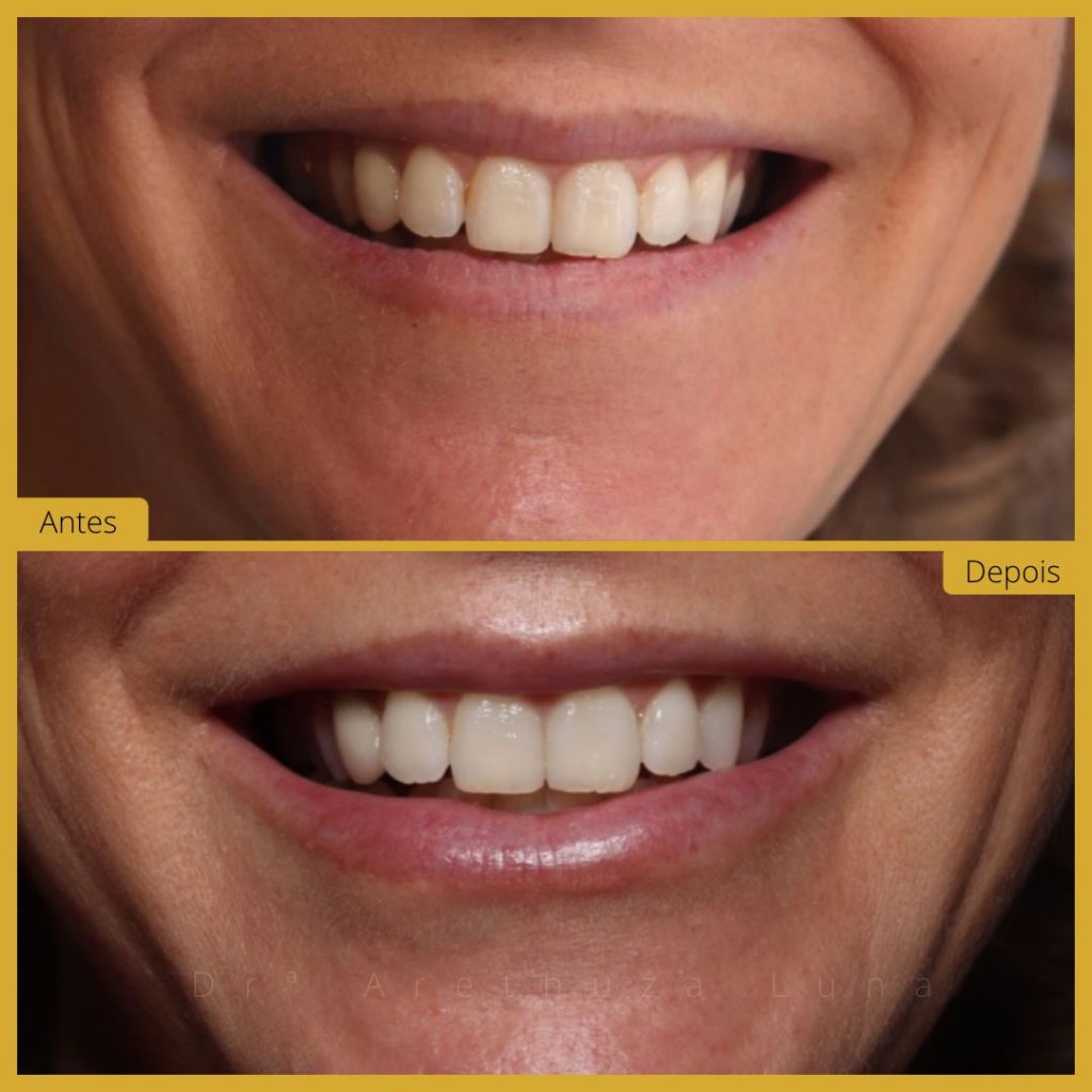 Preenchimento labial - Caso 2